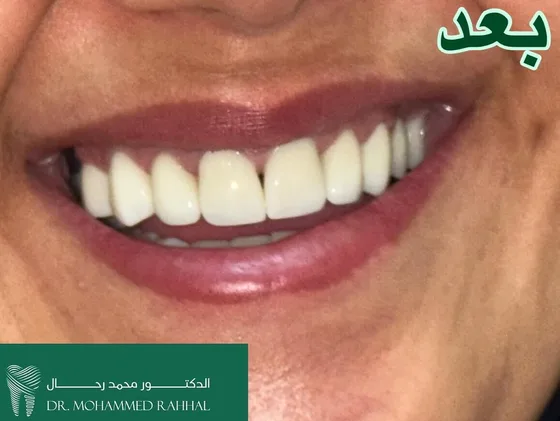 Smile after full-mouth zirconia rehabilitation — Rahhal Dental, Amman