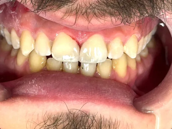 Patient smile after alignment and cosmetic restoration — Rahhal Dental, Amman