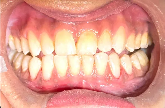 Smile after cosmetic rebuild — Dr. Rahhal specialist clinic, Amman, Jordan