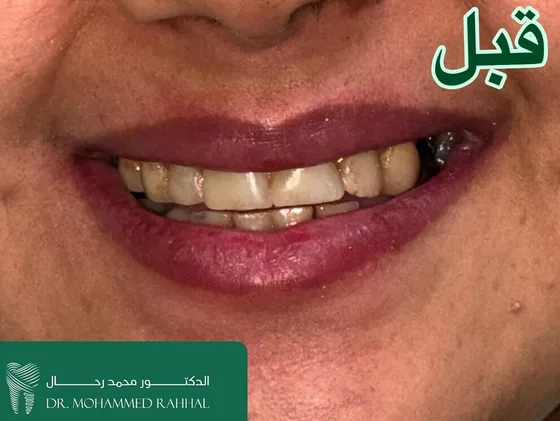 Smile before full-mouth zirconia rehabilitation at the Rahhal dental clinic, Amman