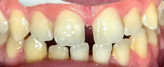 Patient smile before alignment and cosmetic restoration, Rahhal Dental Amman