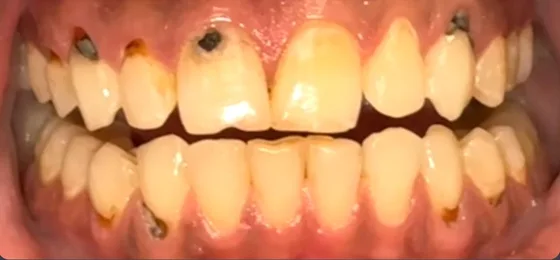 Smile before decay removal and cosmetic rebuild — specialist clinic Amman