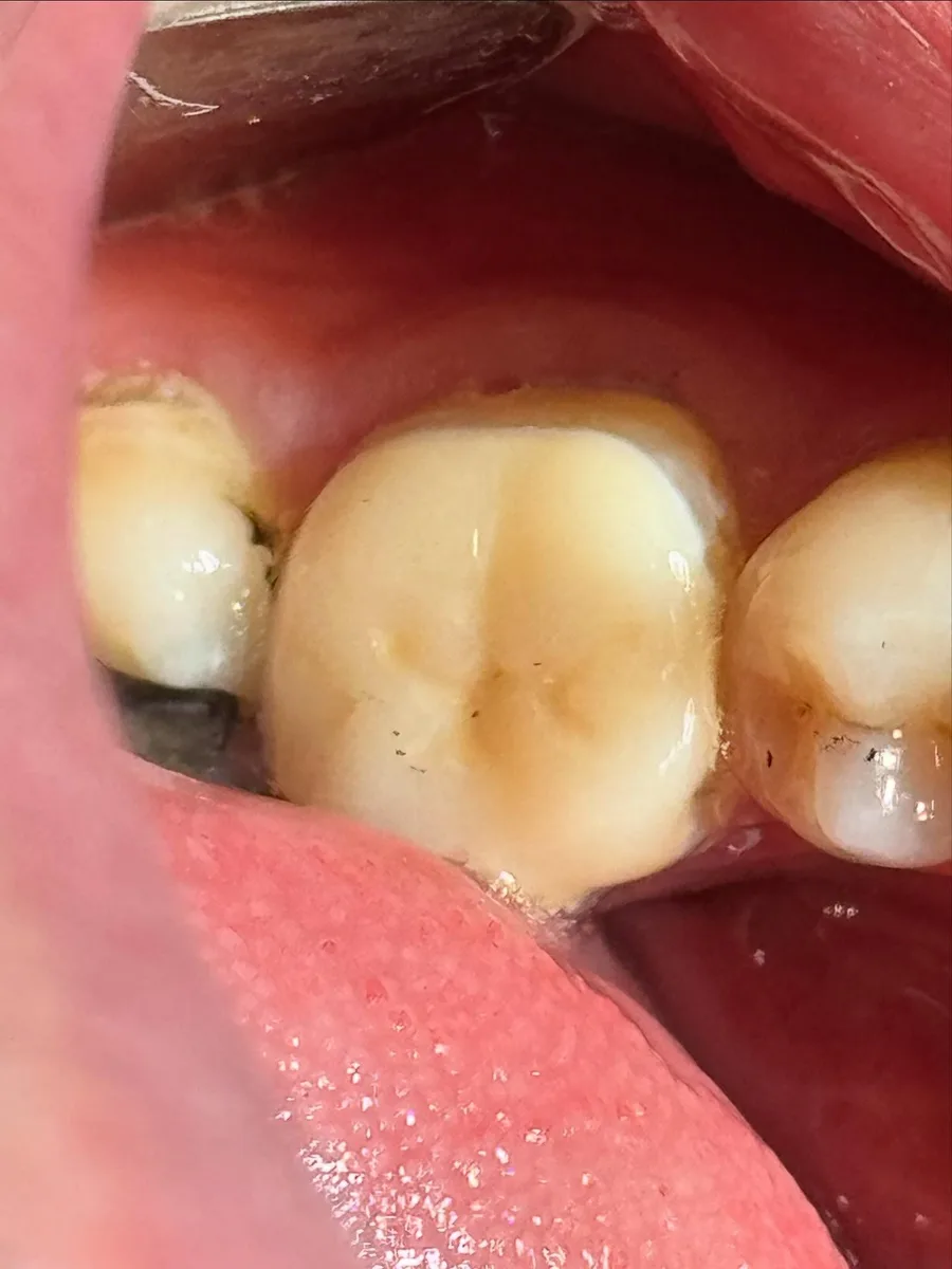 Lower-left first molar after endodontic retreatment and crown restoration