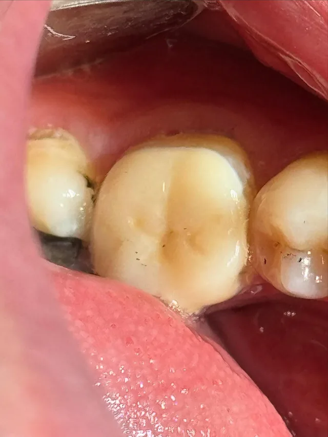 Lower-left first molar after endodontic retreatment and crown restoration